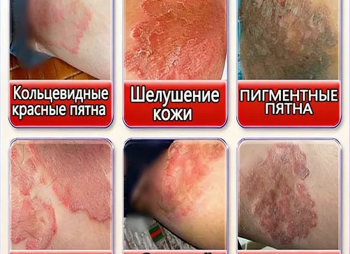 Паховый микоз