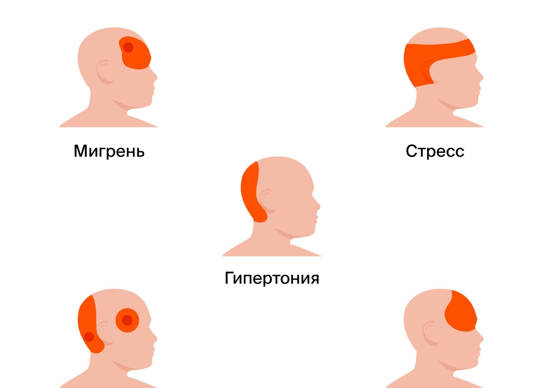 Виды головной боли: чем различаются и как избавиться от каждого из них