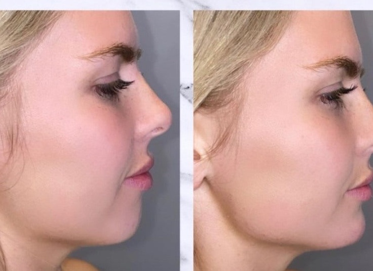 На коже подбородка и шеи много маленьких гнойничков