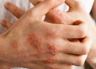 Нейродермит на руках