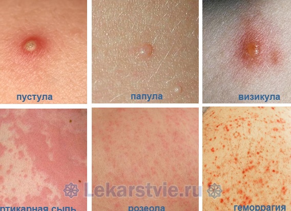 Сыпь у взрослых