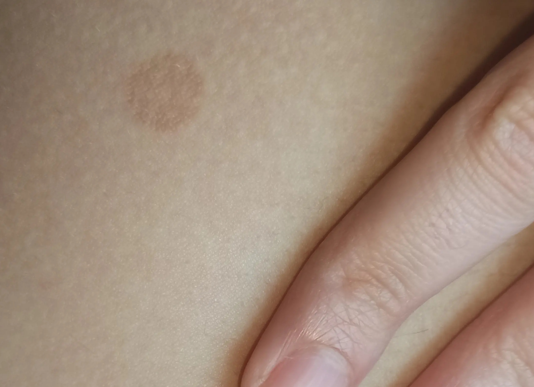 Коричневые пятна на коже под мышками и под грудями