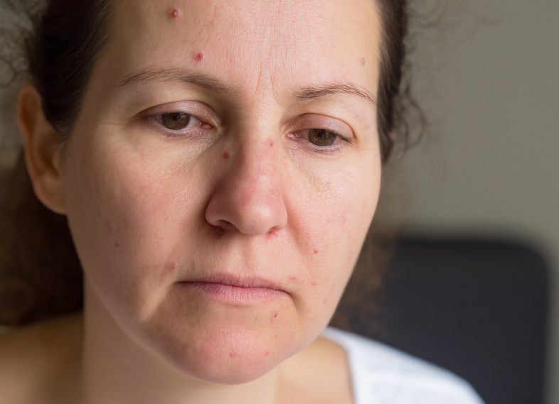 Основные причины появления псориаза