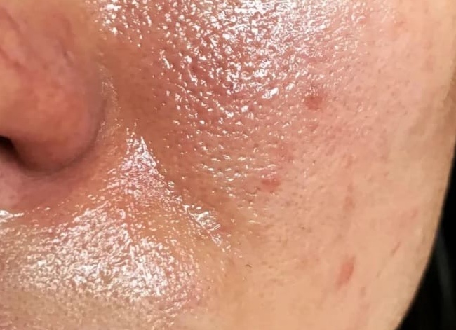 Жирная кожа