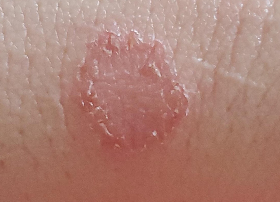 Микоз гладкой кожи