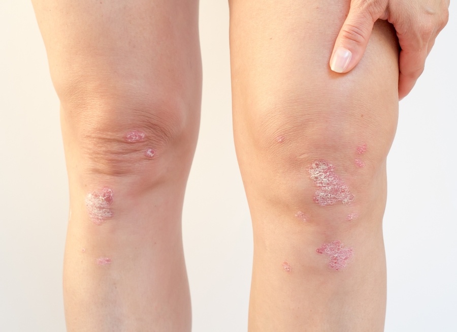 Профилактика эритемы