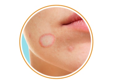 Профилактика стрептодермии