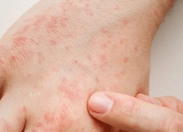 Сыпь на руках