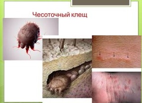 Чесоточный клещ