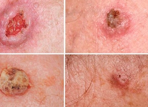 Кожные болезни у стариков