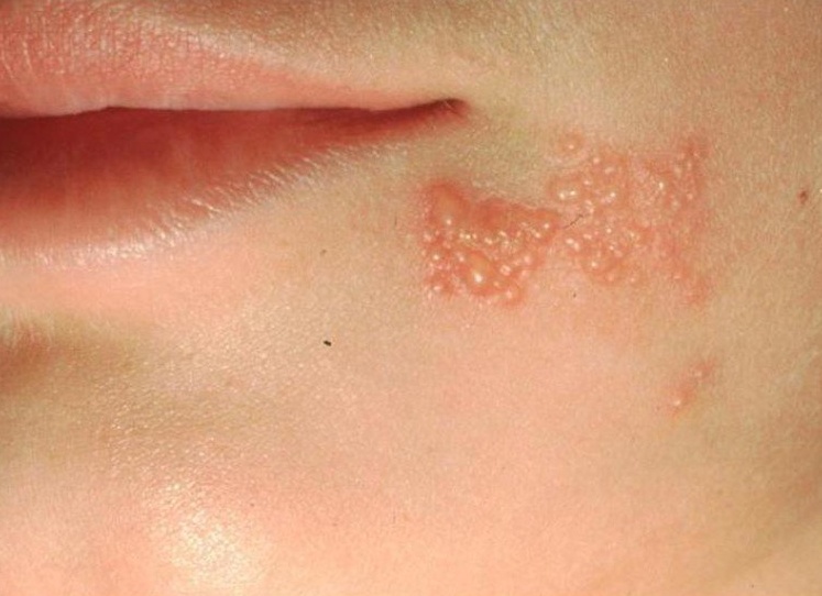 Стрептодермия на лице