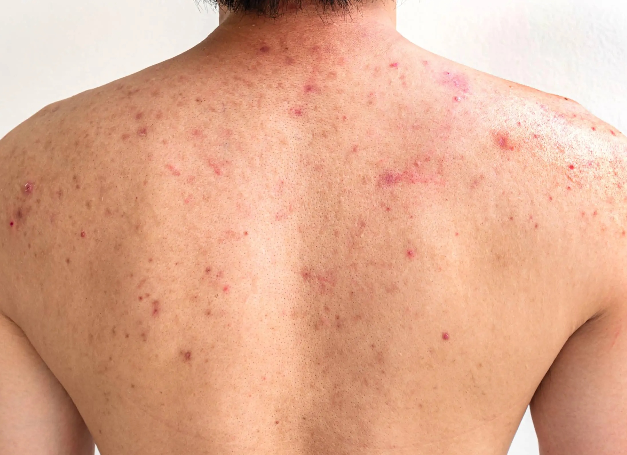 Сыпь на спине