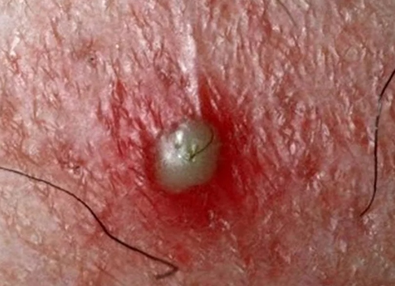 Стафилодермия у взрослых