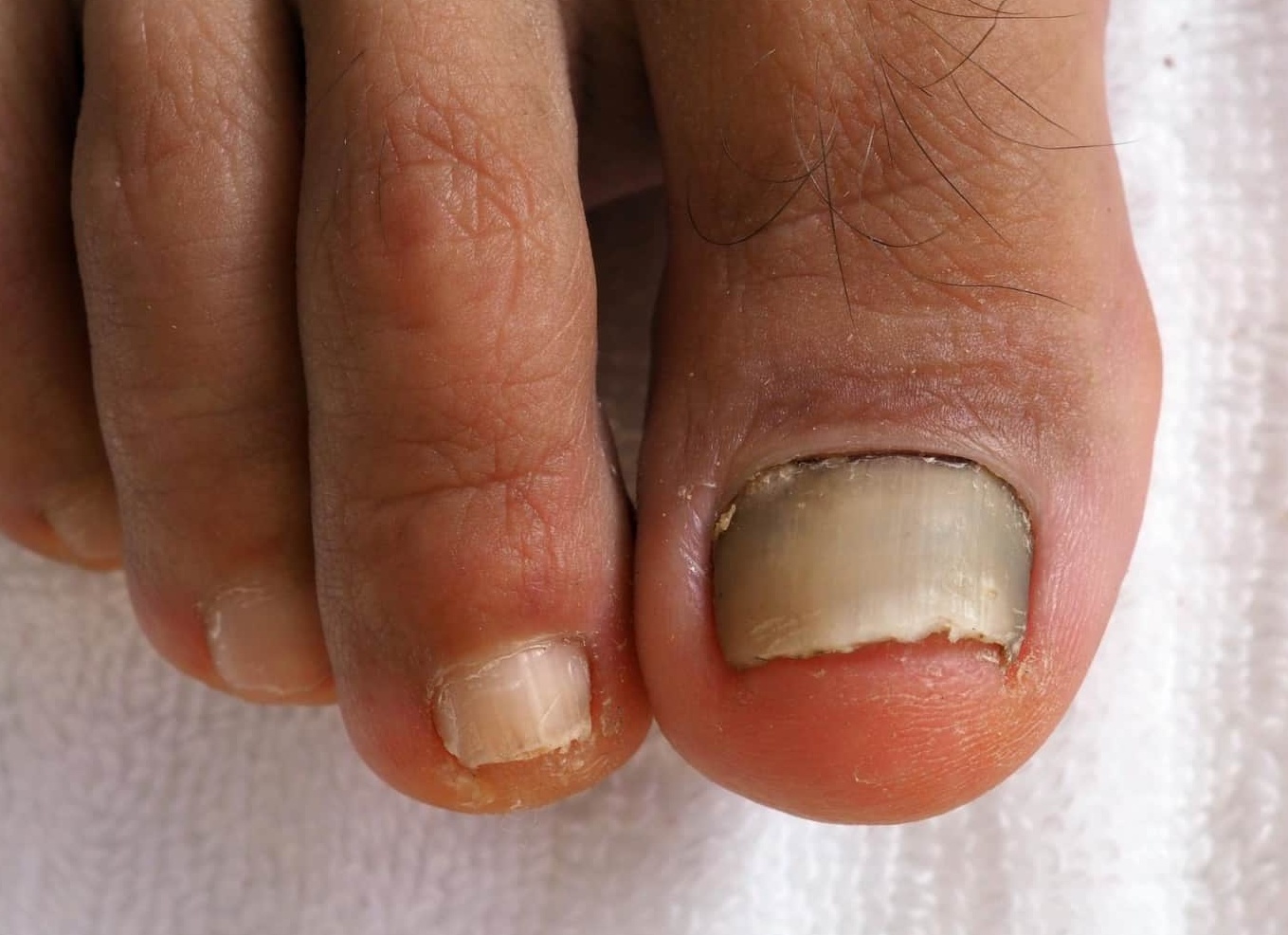 Эпидермофития ногтей