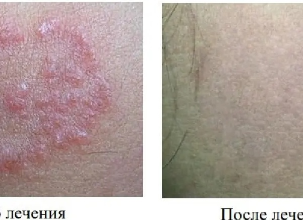 Монетовидная экзема