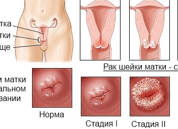 Откуда берётся рак шейки матки и как его лечить