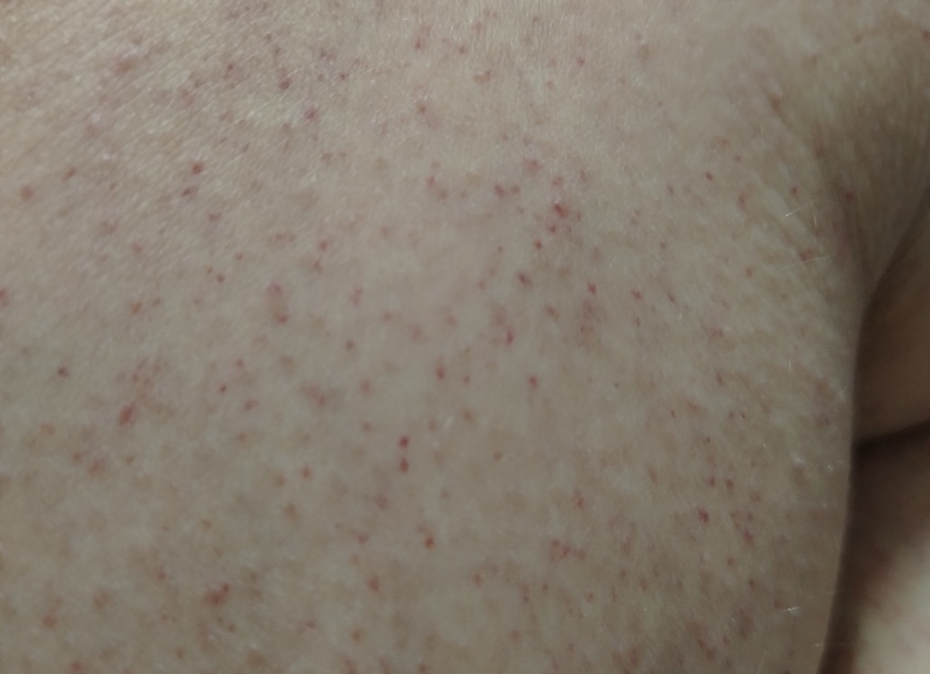 Появились какие-то мелкие пятна на коже – сначала на лице, а потом — на туловище