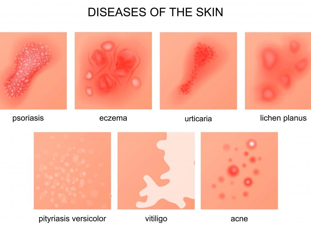 Лечение кожных заболеваний