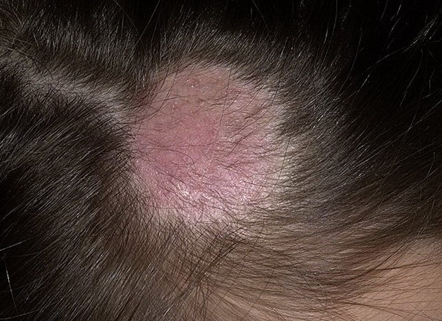 Микоз головы