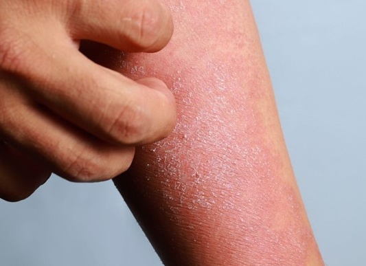 Кожный зуд на руках