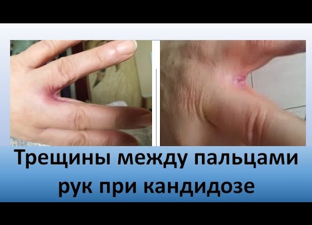 Зуд между пальцами