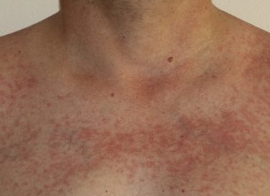 Аллергия на солнце: как выглядит и как её лечить