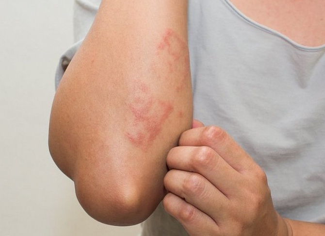 Нейродермит у взрослых