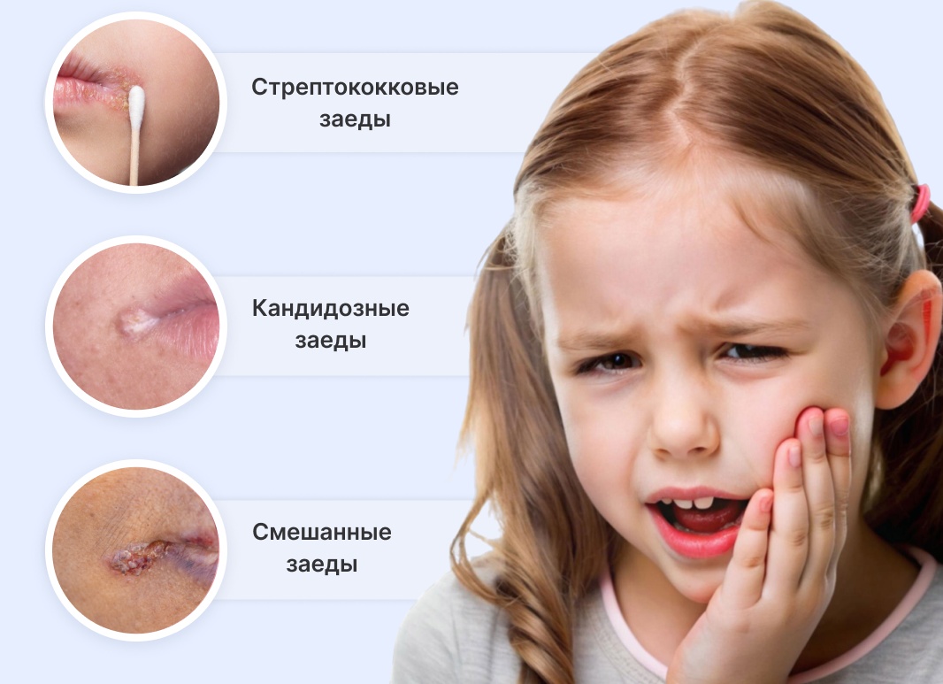 Откуда берутся заеды на губах и как от них избавиться