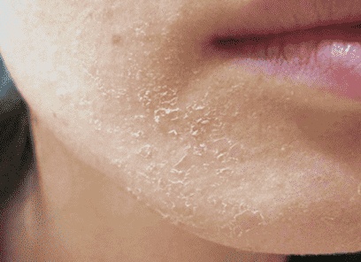 Почему шелушится кожа на лице и что с этим делать