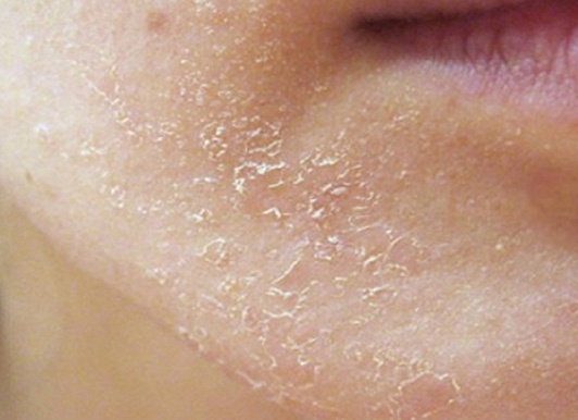 Причины шелушения на коже