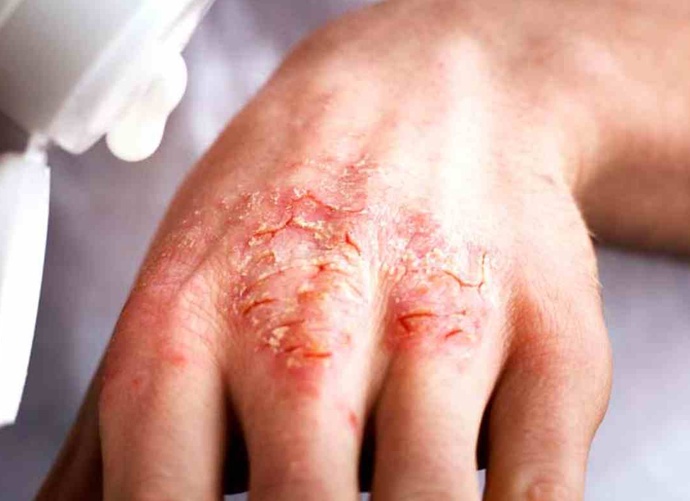 Хроническая экзема