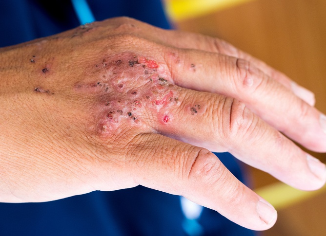 Диагностика стрептодермии