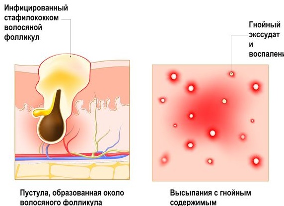 Профилактика стафилодермии
