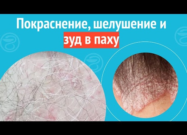 Шелушение кожи в паху