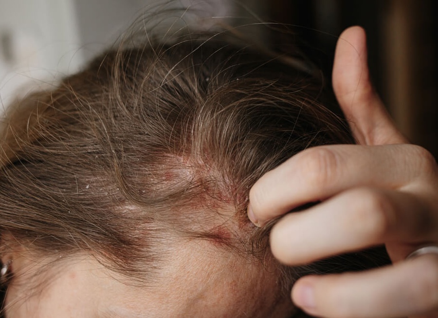 Кожный зуд на голове