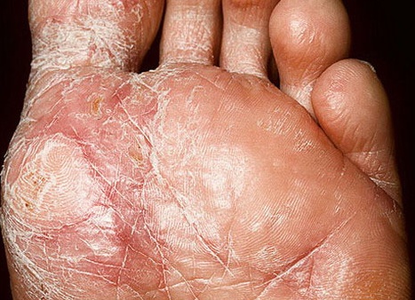 Экзема на ногах