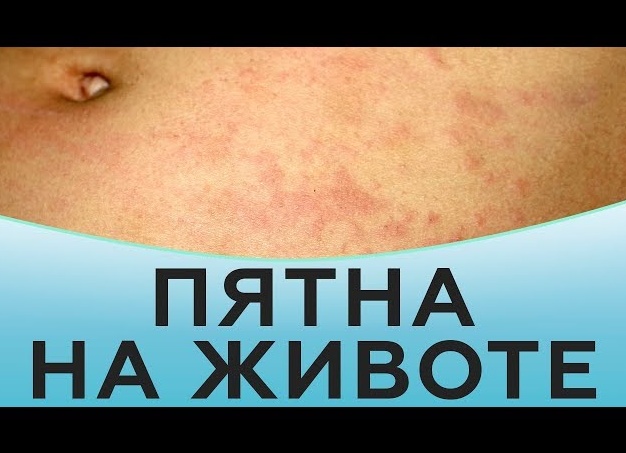 Пятна на коже живота