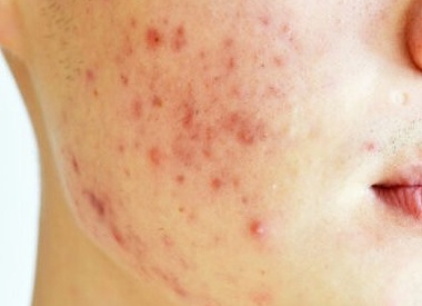 Как избавиться от постакне