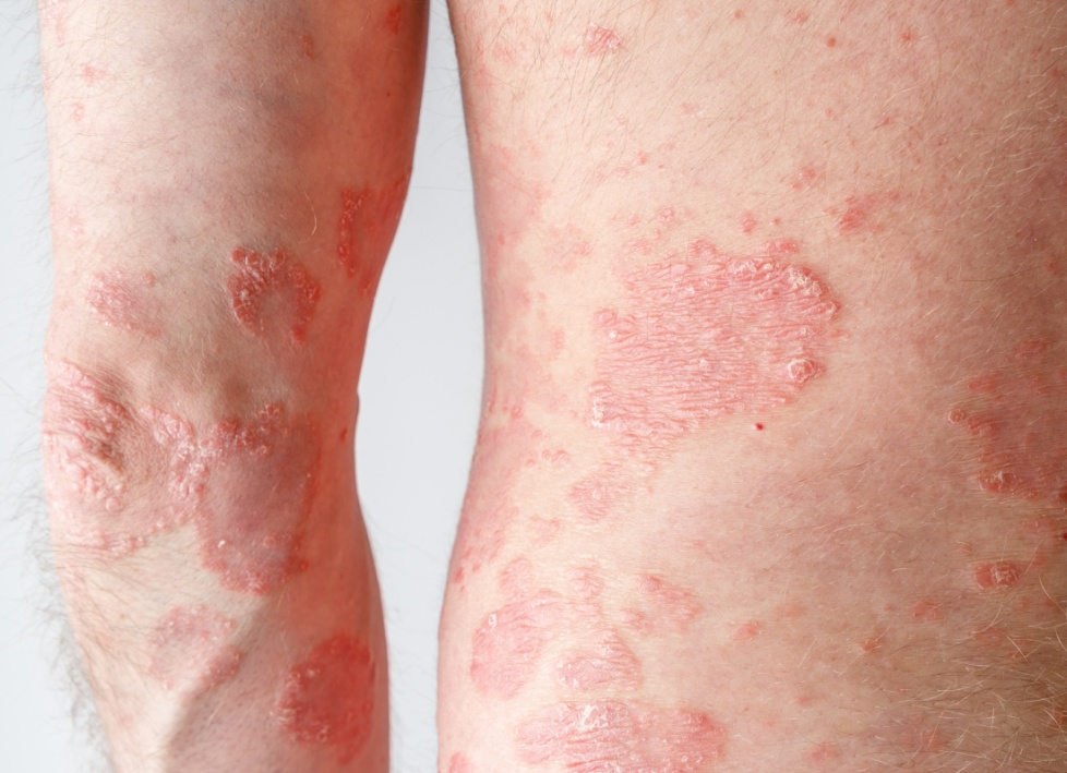 Симптомы розового лишая