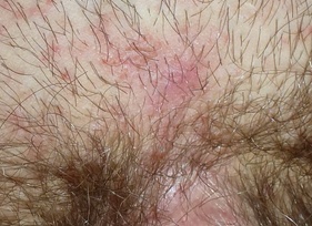 Сыпь на лобке