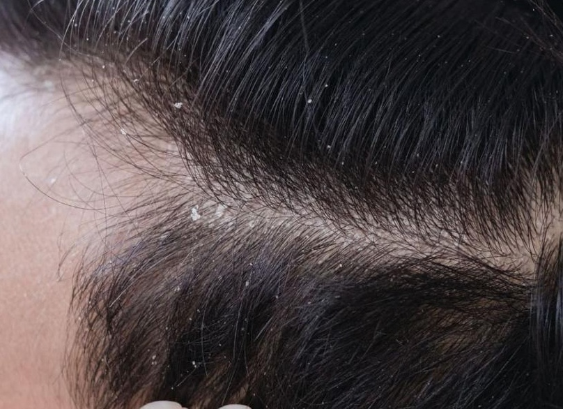 Сухая себорея