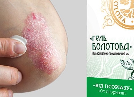 Чем лечить псориаз?