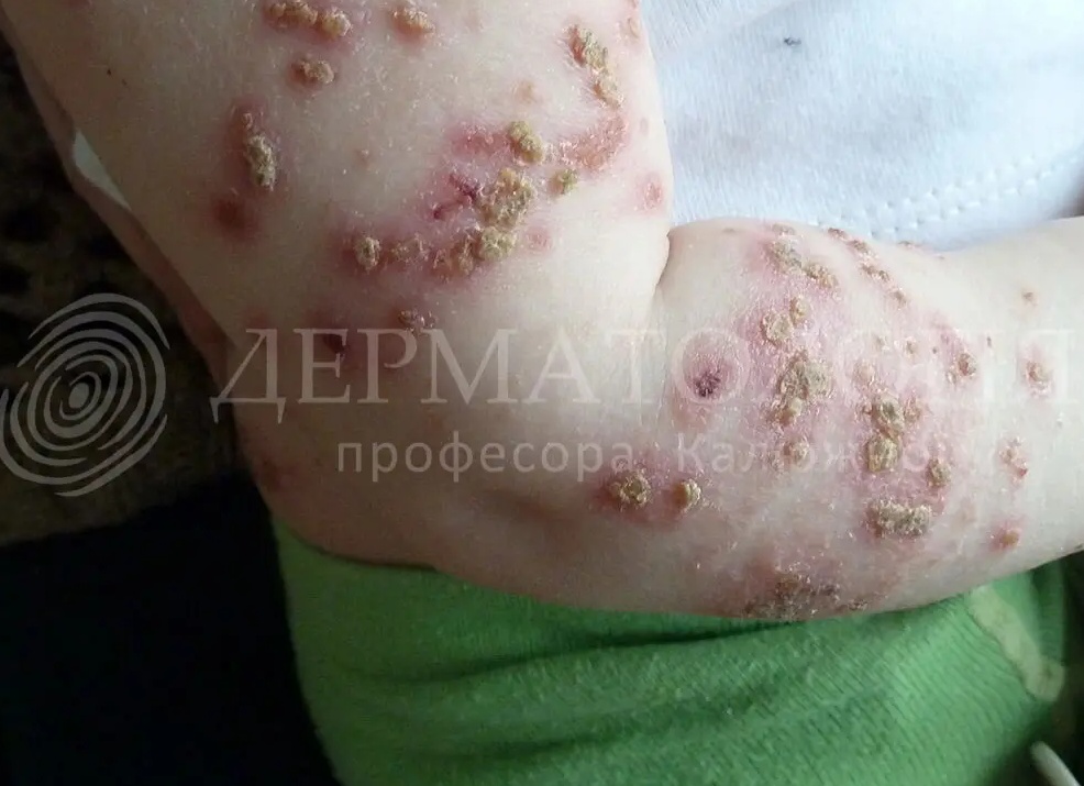 Пиодермия у детей