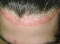 Причины появления себореи