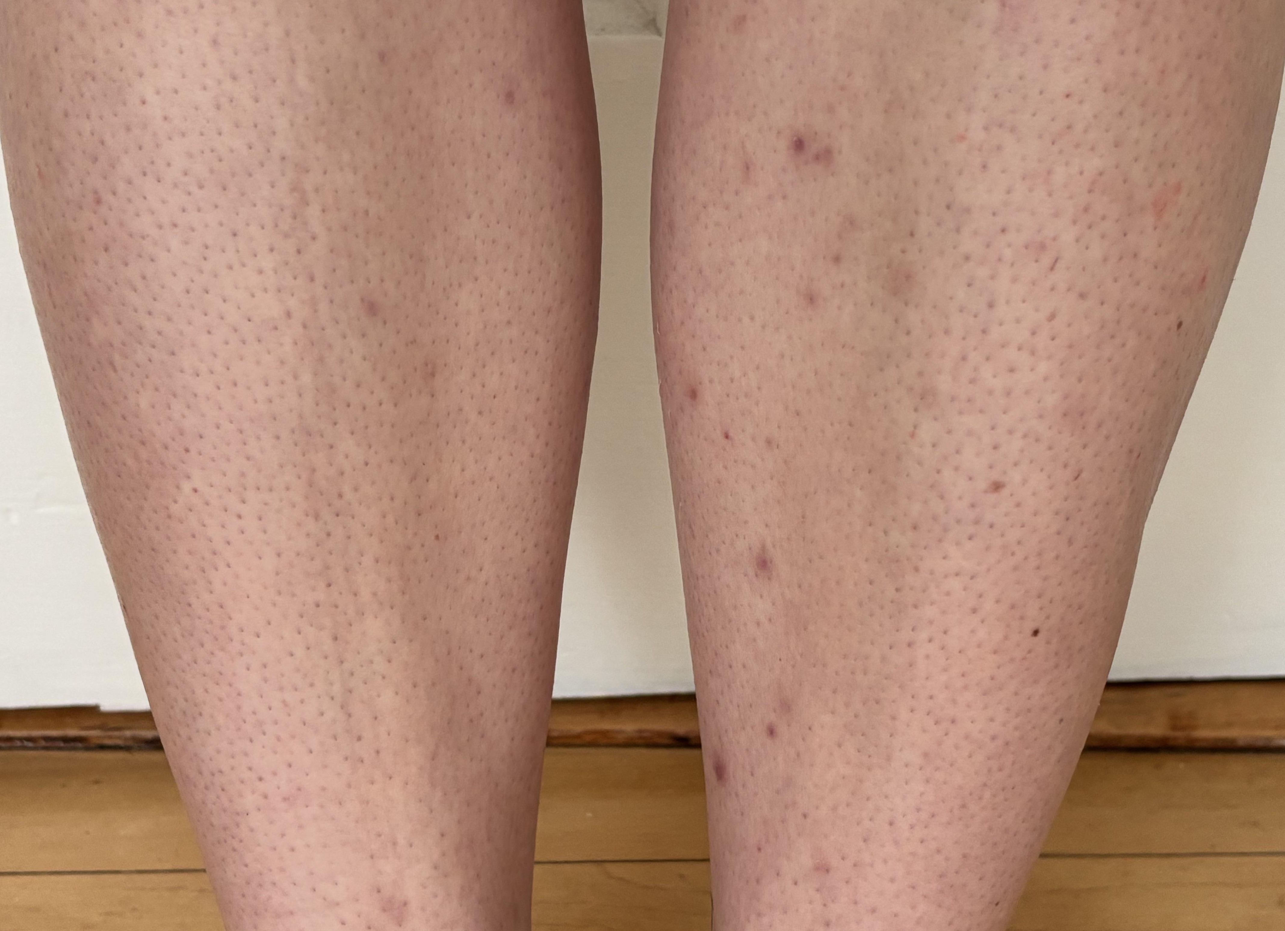 Пятна на коже ног