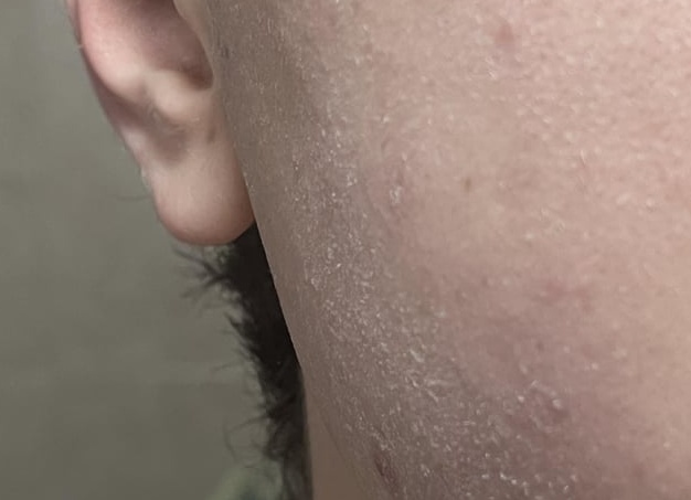 Шелушение кожи ушей