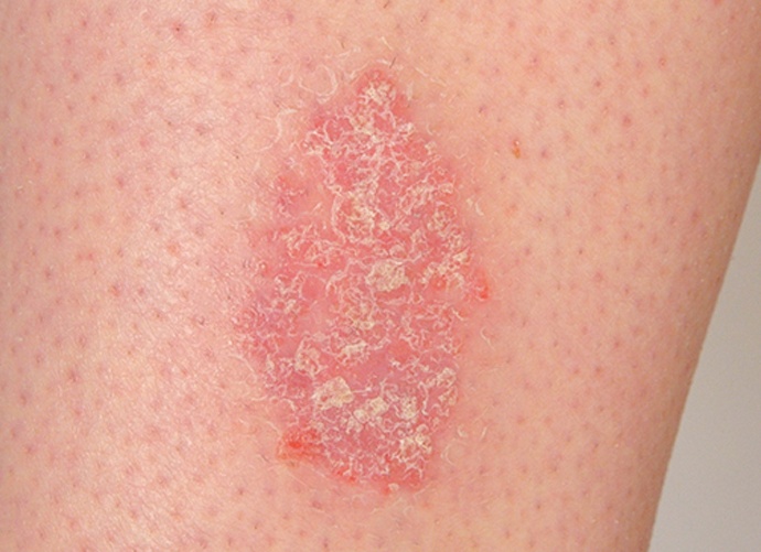 Шелушение кожи на теле