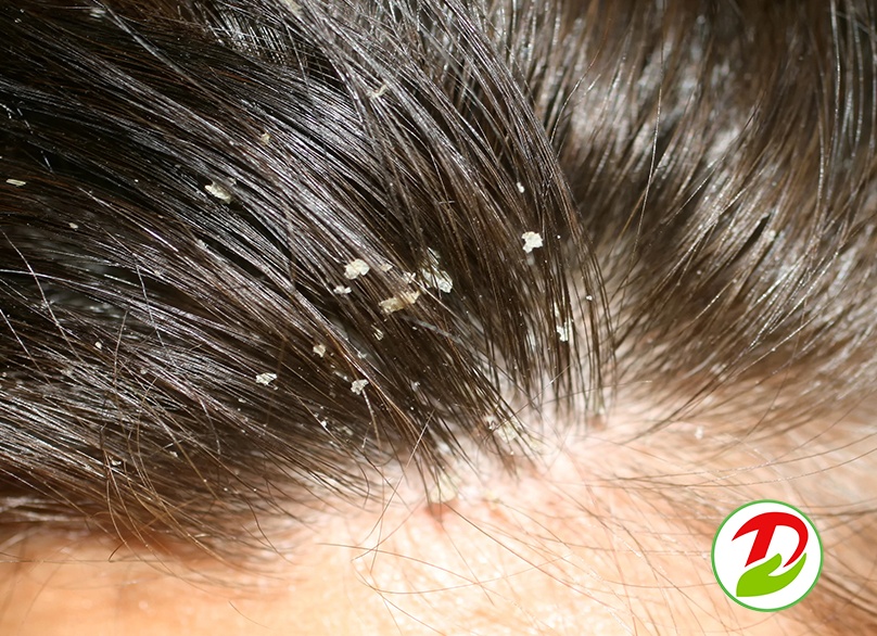 Шелушение кожи головы