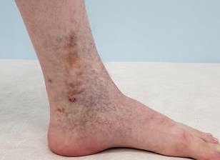 Варикозная экзема