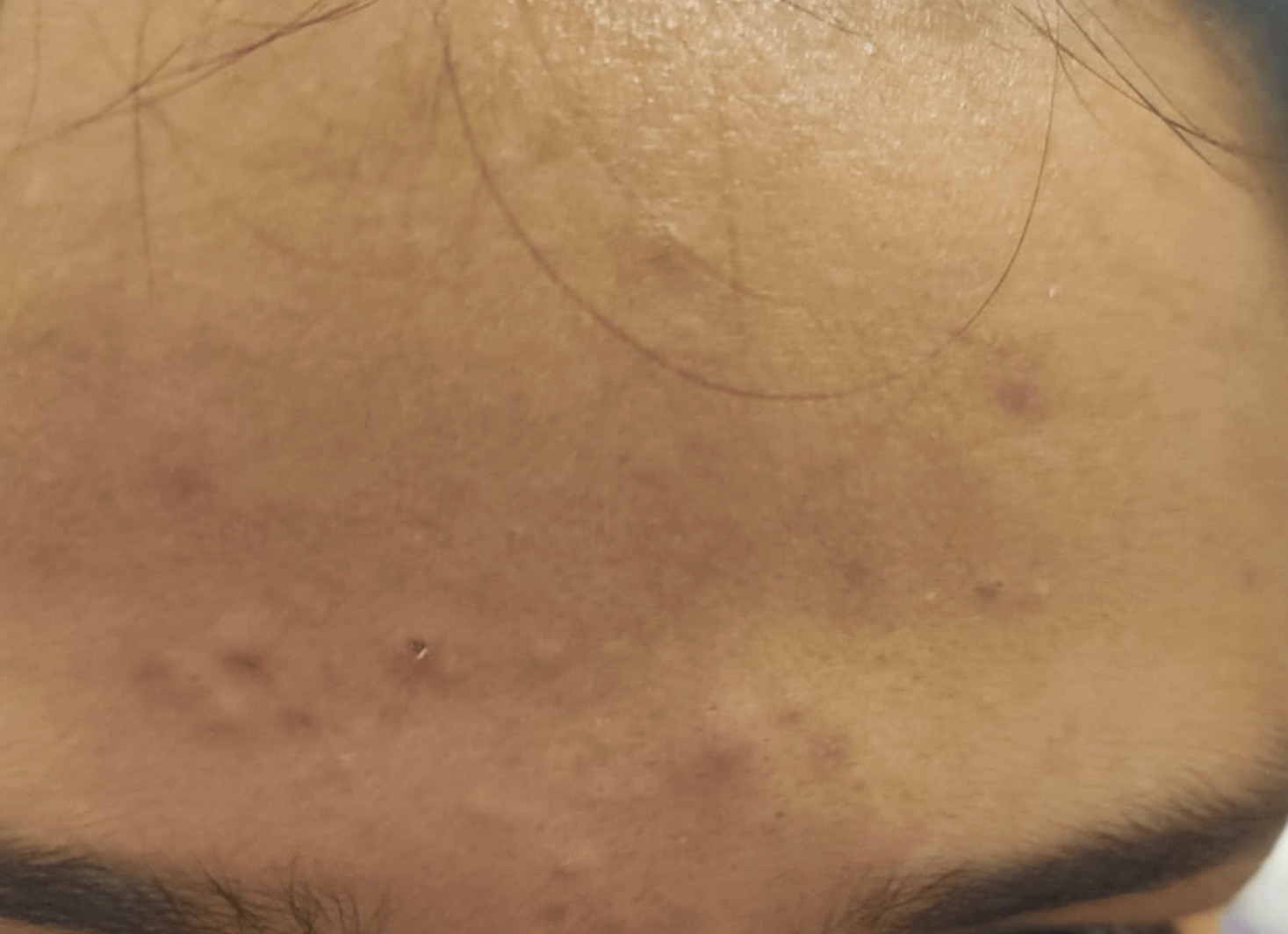 Сыпь на лице